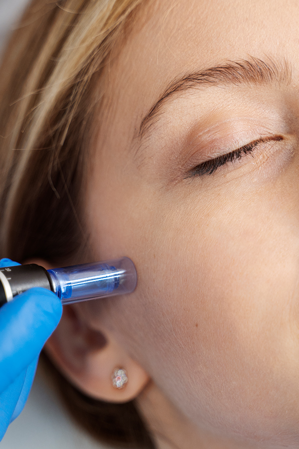 SYLFIRM X RF Microneedling Melbourne – Advanced Skin Tightening